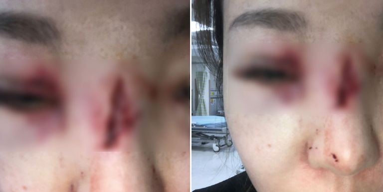 골프공에 맞은 캐디 B씨는 평생 시력을 잃을 위기에 놓였다. /피해자 측 제공