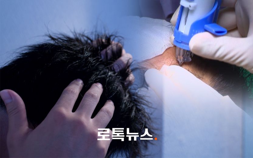 멀쩡한 머리 뽑아 이식했는데, 사라진 머리카락…환불이 끝? 손해배상 여부 따져봤다 기사 관련이미지