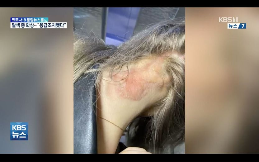 뜨거워도 참고 탈색했더니 '3도 화상'…미용사는 "책임 없다"는데, 그럼 누구 책임? 기사 관련이미지