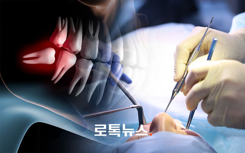 사랑니 뽑다가 환자 입술에 상처 입힌 치과의사…벌금 300만원 기사 관련이미지