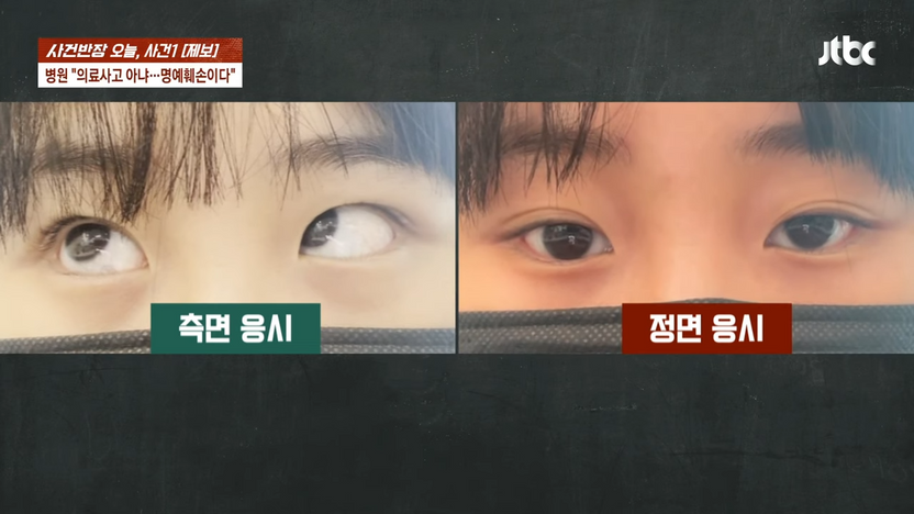 눈 밑 지방 제거 수술 후 '사시'…의료사고일까, 매우 드문 합병증일까 기사 관련이미지