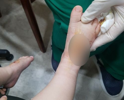 왼쪽 발등에 염증을 제거하는 수술을 받기로 한 생후 20개월 된 아기가 수술실에 들어간 뒤 오른쪽 발등을 수술하고 나왔다. /연합뉴스